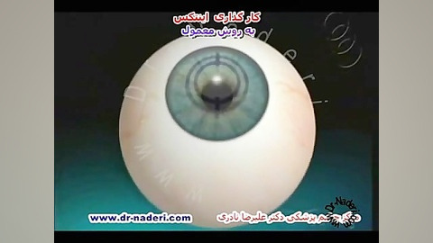 عمل رینگINTACSبه روش معمول -سایت چشم پزشکی دکترناد ری مرکز چشم پزشکی دکتر علیرضا نادری www.dr-naderi.com
