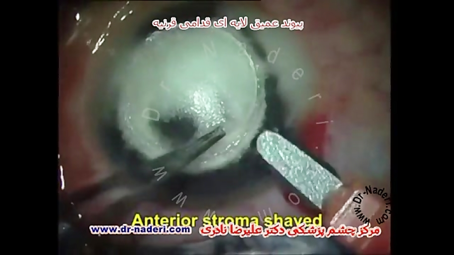 پیوند لایه ای قرنیهDALK-مرکز چشم پزشکی دکترعلیرضا نادری مرکز چشم پزشکی دکتر علیرضا نادری www.dr-naderi.com