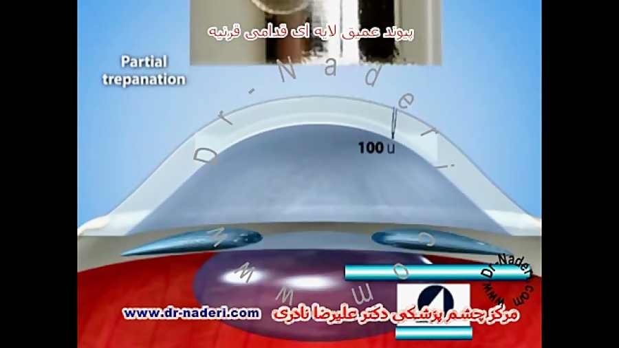 انیمیشن پیوندلایه ای قرنیهDALK-مرکز چشم پزشکی دکترنادری مرکز چشم پزشکی دکتر علیرضا نادری www.dr-naderi.com