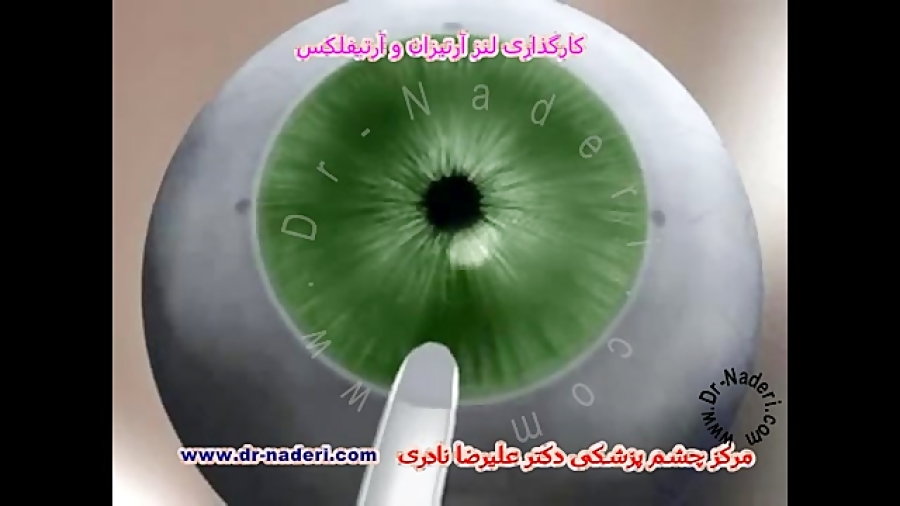 لنزداخل چشمی آرتیفلکس -مرکز چشم پزشکی دکتر علیرضا نادری مرکز چشم پزشکی دکتر علیرضا نادری www.dr-naderi.com
