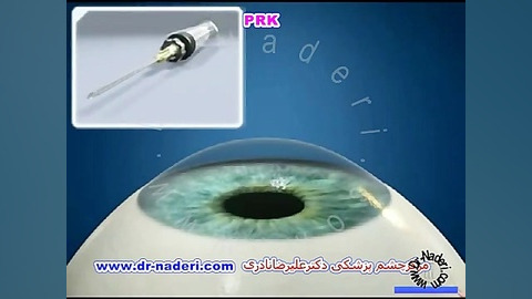 لیزر پی آر کی PRK - مرکز چشم پزشکی دکتر علیرضا نادری مرکز چشم پزشکی دکتر علیرضا نادری www.dr-naderi.com