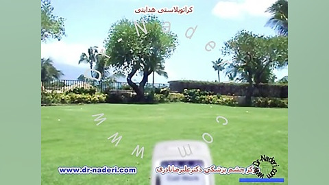 کراتوپلاستی هدایتی - مرکز چشم پزشکی دکتر علیرضا نادری مرکز چشم پزشکی دکتر علیرضا نادری www.dr-naderi.com