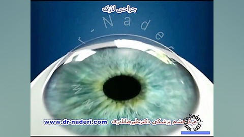 عمل لازک - مرکز چشم پزشکی دکتر علیرضا نادری مرکز چشم پزشکی دکتر علیرضا نادری www.dr-naderi.com