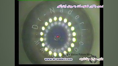 لیزر پیرچشمی (اینتراکور) - مرکز چشم پزشکی دکتر نادری مرکز چشم پزشکی دکتر علیرضا نادری www.dr-naderi.com