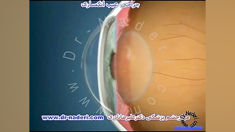 جراحی عیوب انکساری - مرکز چشم پزشکی دکتر علیرضا نادری مرکز چشم پزشکی دکتر علیرضا نادری www.dr-naderi.com