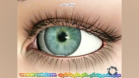 نزدیک بینی - مرکز چشم پزشکی دکتر علیرضا نادری مرکز چشم پزشکی دکتر علیرضا نادری www.dr-naderi.com