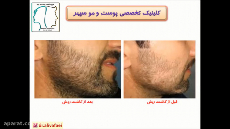 کاشت ریش و سبیل دکتر علی وفائی - متخصص پوست و مو