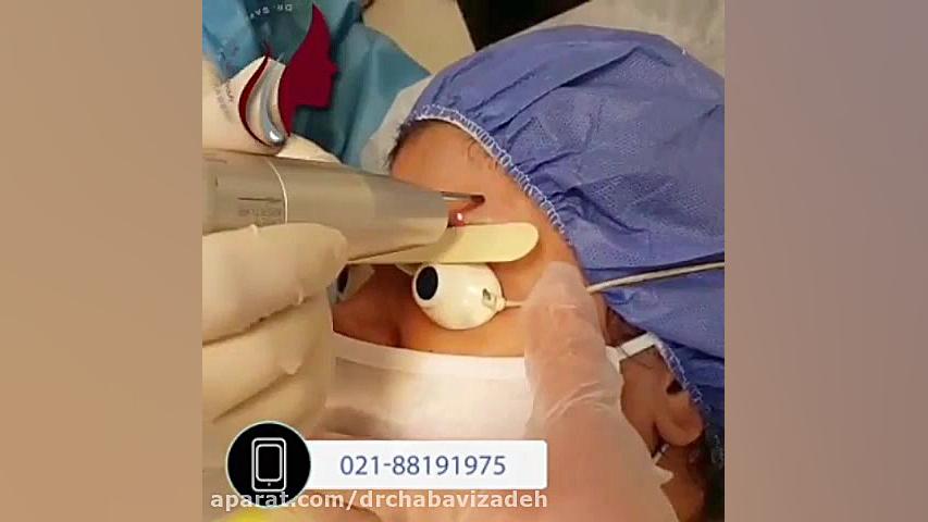 پاک کردن تاتو ابرو دکتر صفیه چعباوی زاده