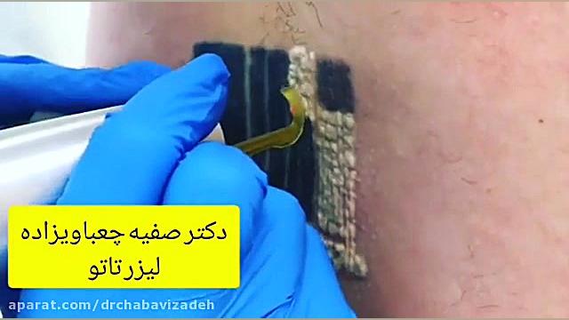 لیزر کردن تاتو دکتر صفیه چعباوی زاده