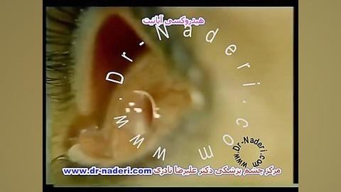 هیدروکسی آپاتیت وکارگذاری پروتز-مرکزچشم پزشکی دکترنادری مرکز چشم پزشکی دکتر علیرضا نادری www.dr-naderi.com