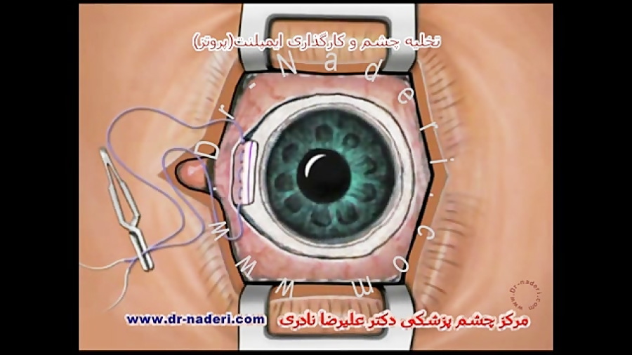 تخلیه چشم و کارگذاری پروتز-سایت چشم پزشکی دکتر نادری مرکز چشم پزشکی دکتر علیرضا نادری www.dr-naderi.com