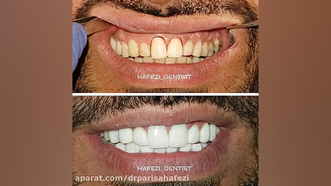 فیلم تعویض روکش دندان جلویی و کامپوزیت توپلیزوماب