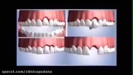 مقایسه دندان مصنوعی متحرک با بریج و ایمپلنت کولفی‌تیل