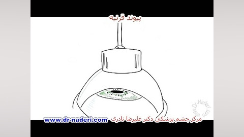 مروری کلی بر پیوند قرنیه - سایت چشم پزشکی دکتر نادری مرکز چشم پزشکی دکتر علیرضا نادری www.dr-naderi.com