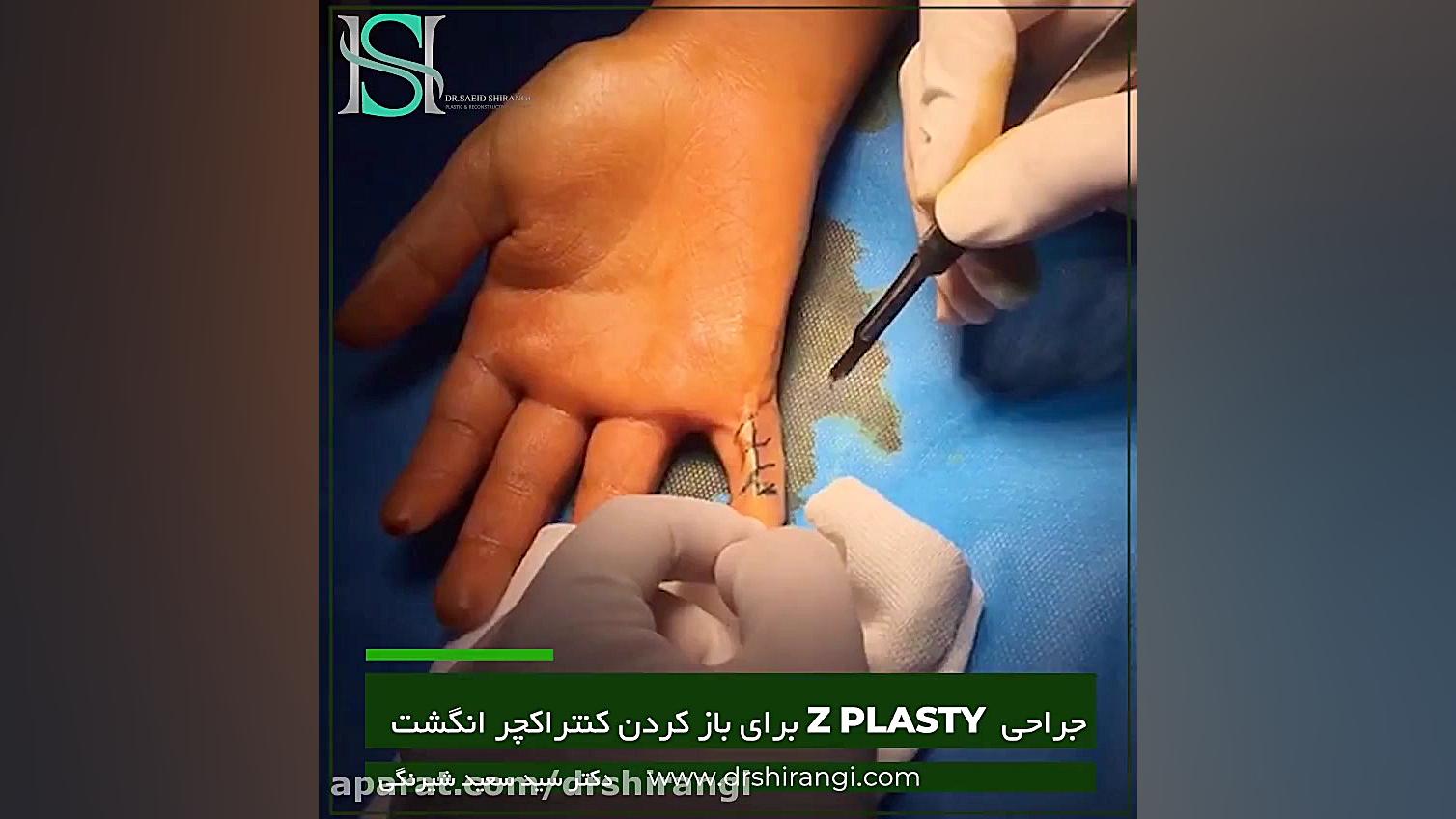 فیلم جراحی z plasty کنتراکچر انگشت دکتر سعید شیرنگی (فوق تخصص جراحی پلاستیک و زیبایی)