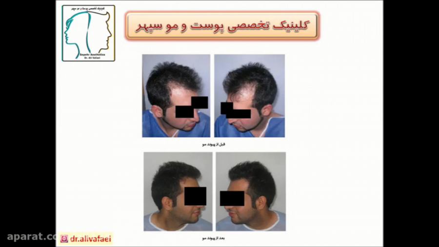 کاشت مو در اسکار دکتر علی وفائی - متخصص پوست و مو