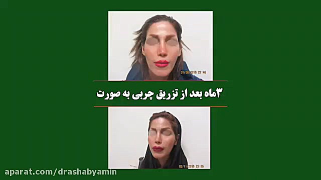 تزریق چربی به صورت دکتر محمودرضا اصحاب یمین - فوق تخصص پلاستیک