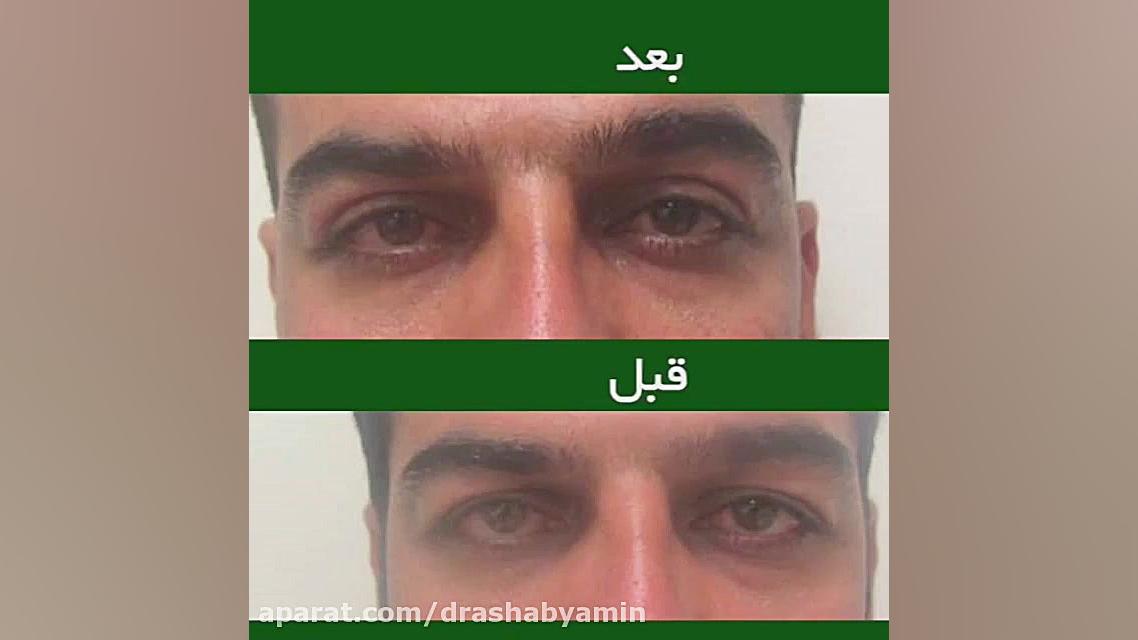 بلفاروپلاستی دکتر محمودرضا اصحاب یمین - فوق تخصص پلاستیک