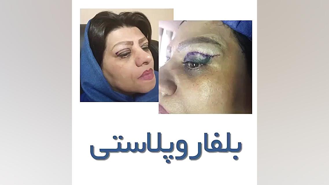 جراحی پلک بالا بدون سانسور دکتر بابک جعفرنژاد