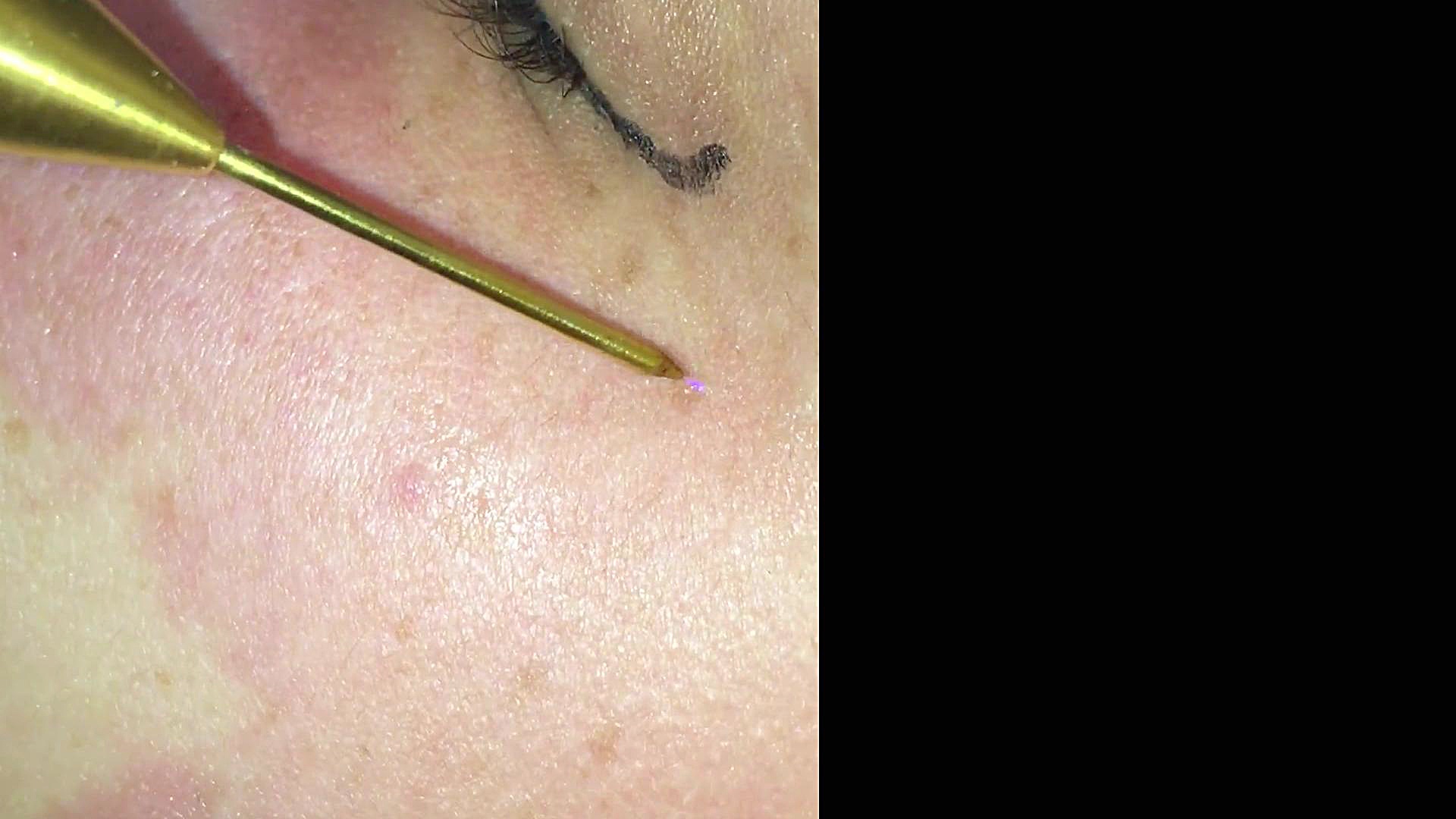 رفع لک صورت با پلاسماجت در مطب خانم دکتر متینه پاکیده 02176701944 لباس اگزواسکلتون پزشکی