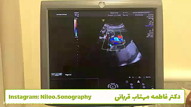 سونوگرافی کالر داپلر سونوگرافی نیلو دکتر فاطمه مهتاب قربانی