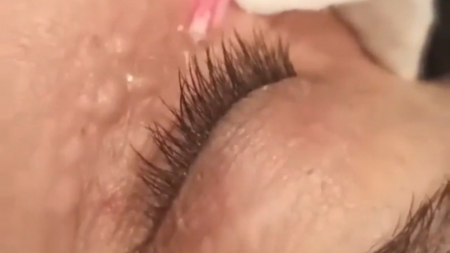 مزوتراپی زیر چشم لیفت صورت