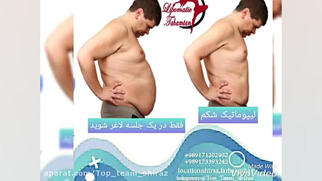 لیپوساکشن شکم پهلو زاویه سازی صورت