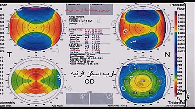 معاینات قبل از عمل لیزیک و لازک-مرکزچشم پزشکی دکترنادری مرکز چشم پزشکی دکتر علیرضا نادری www.dr-naderi.com
