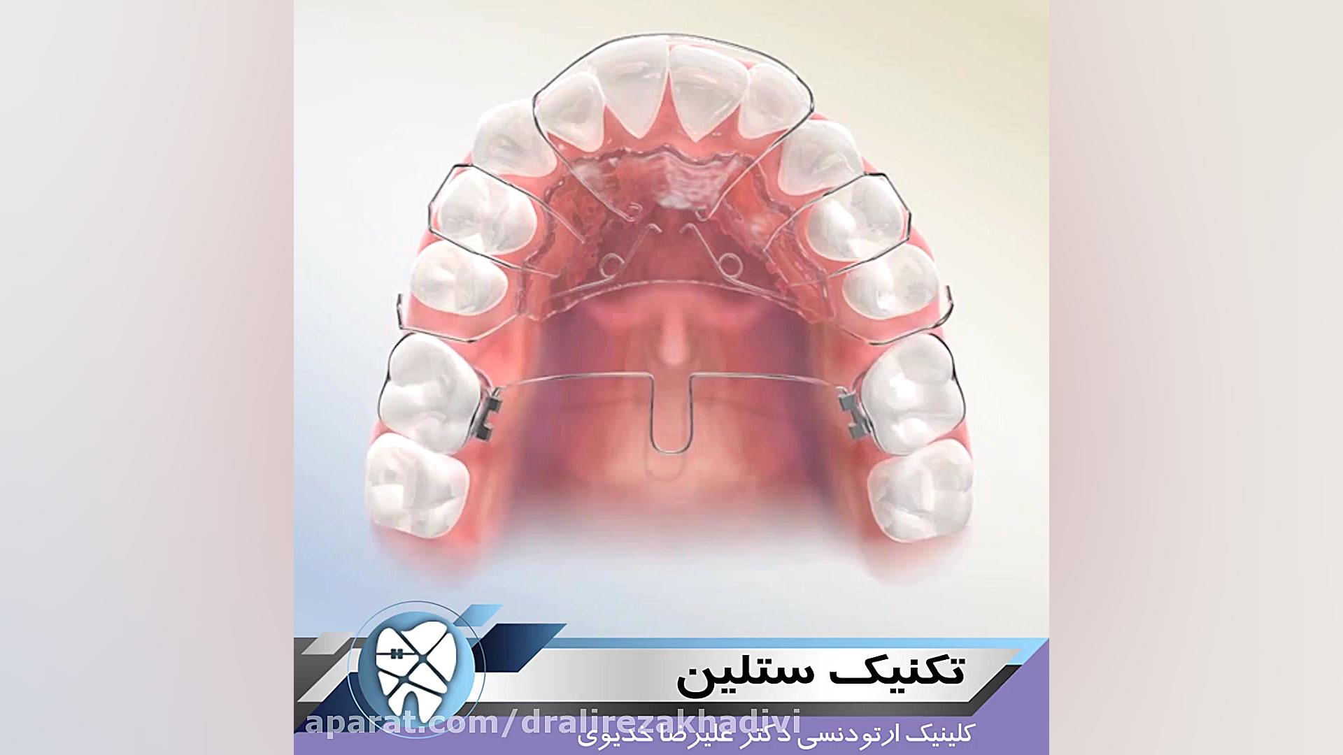 تکنیک ستلین.متخصص ارتودنسی تهران.دکترعلیرضاخدیوی دکتر علیرضا خدیوی