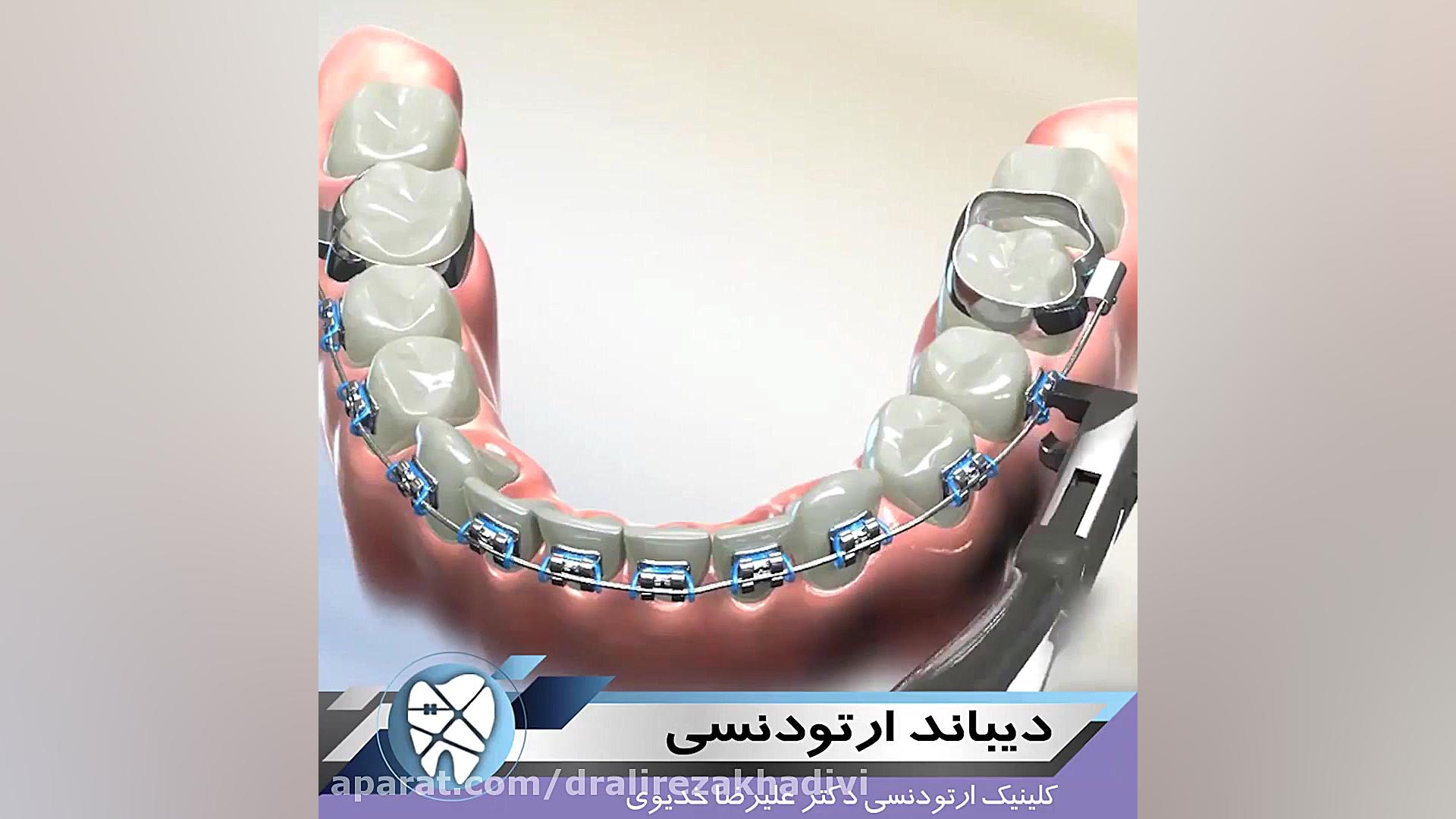 دیباند ارتودنسی.متخصص ارتودنسی تهران.دکترعلیرضاخدیوی دکتر علیرضا خدیوی