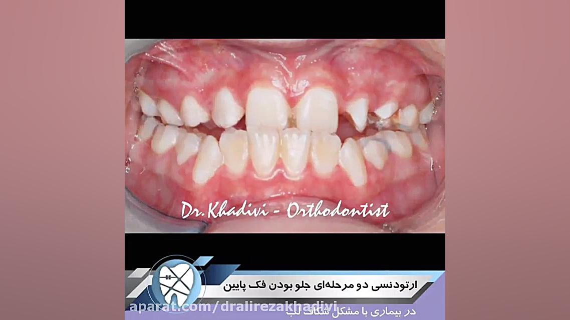 ارتودنسی دو مرحله ای،جلو بودن فک پایین.متخصص ارتودنسی تهران.دکترعلیرضاخدیوی دکتر علیرضا خدیوی