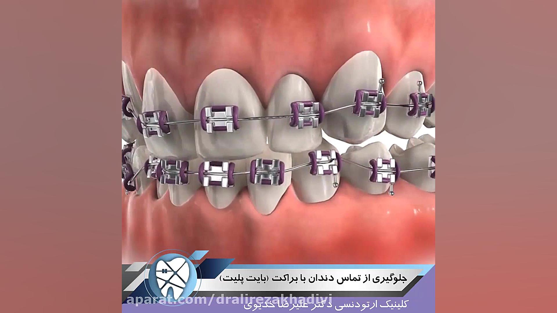 جلوگیری از تماس دندان با براکت.متخصص ارتودنسی.دکتر علیرضاخدیوی دکتر علیرضا خدیوی