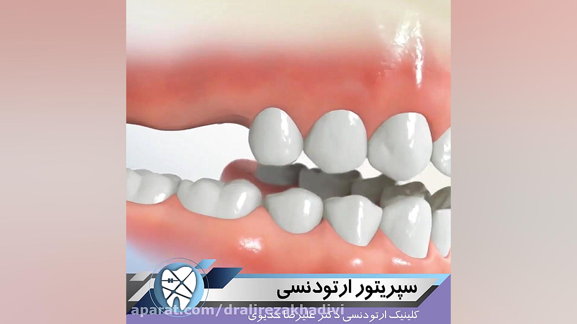 سپریتور ارتودنسی.متخصص ارتودنسی تهران.دکترعلیرضاخدیوی دکتر علیرضا خدیوی