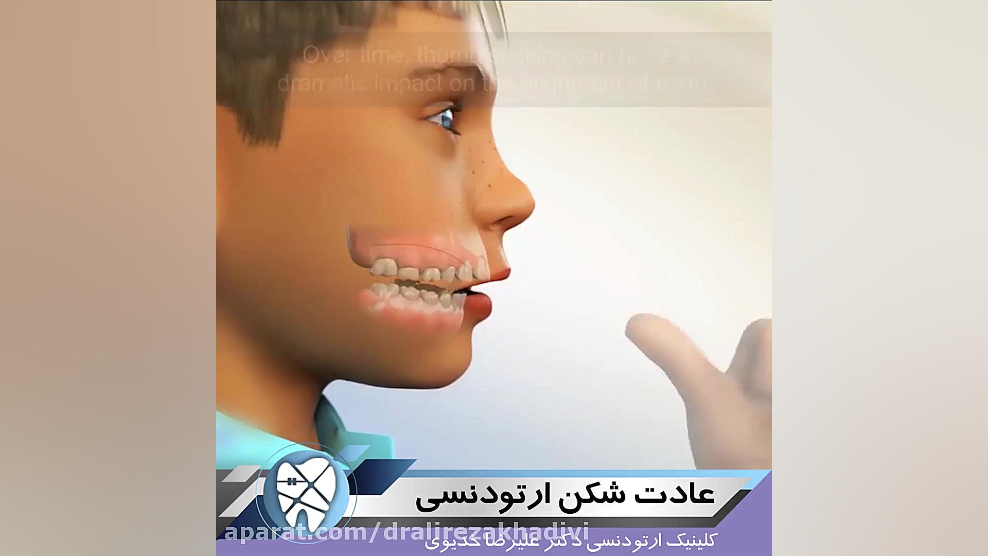 عادت شکن ارتودنسی.متخصص ارتودنسی تهران.دکترعلیرضاخدیوی دکتر علیرضا خدیوی