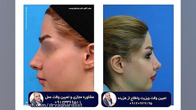جراحی بینی طبیعی دو ماه بعد از عمل درمان ریزش مو