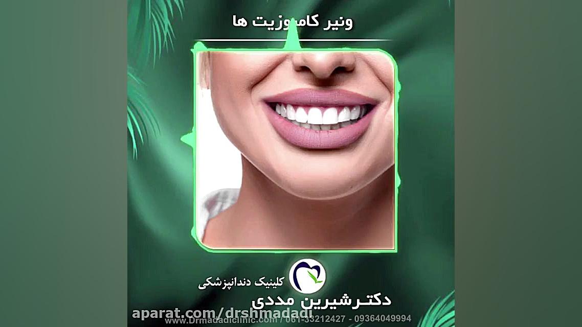 فیلم کامپوزیت ونیر ماموپلاستی