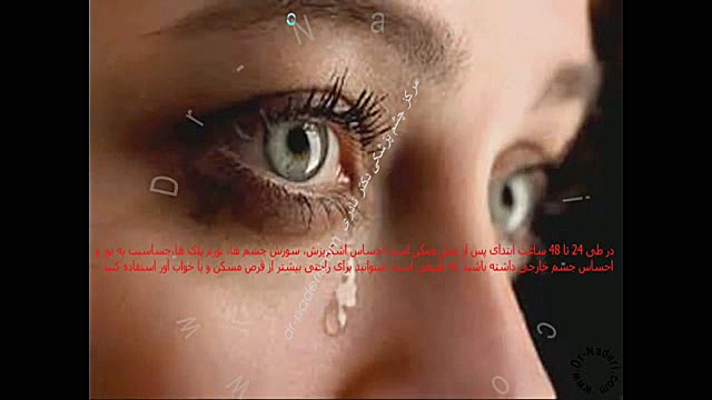 مراقبت پس از لیزیک و لازک وprk- مرکزچشم پزشکی دکترنادری مرکز چشم پزشکی دکتر علیرضا نادری www.dr-naderi.com