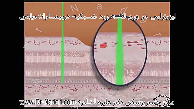 لیزر درمانی در دیابت- مرکز چشم پزشکی دکتر علیرضا نادری مرکز چشم پزشکی دکتر علیرضا نادری www.dr-naderi.com