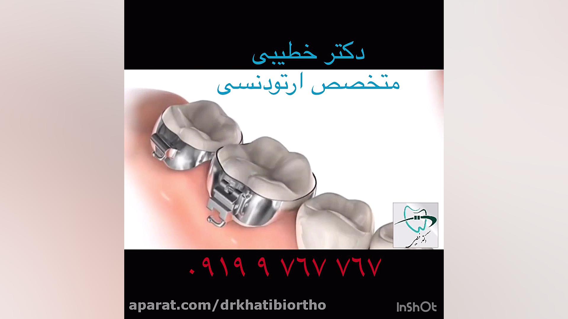 گذاشتن بند (band) ارتودنسى دکتر امیرحسین خطیبی