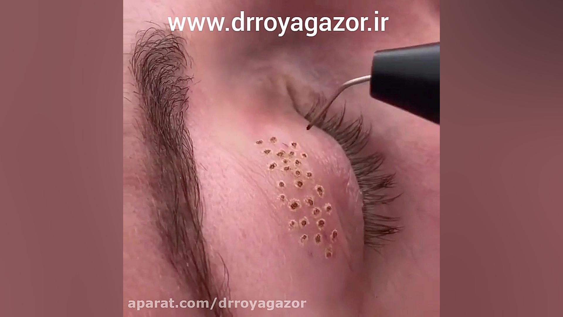 جوانسازی پوست توسط پلاسماجت الکترود اپتوژنزی