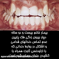 الو دکتر درمان بیرون زدگی فک پ...