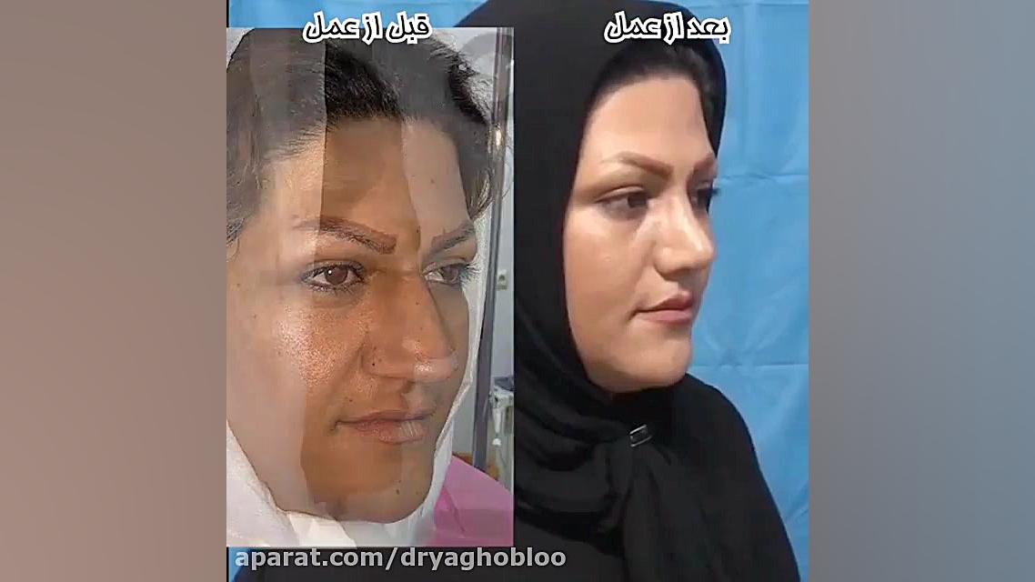 عمل زیبایی بینی | جراحی بینی | دکتر یوسف یعقوبلو اوتیلومیومبر
