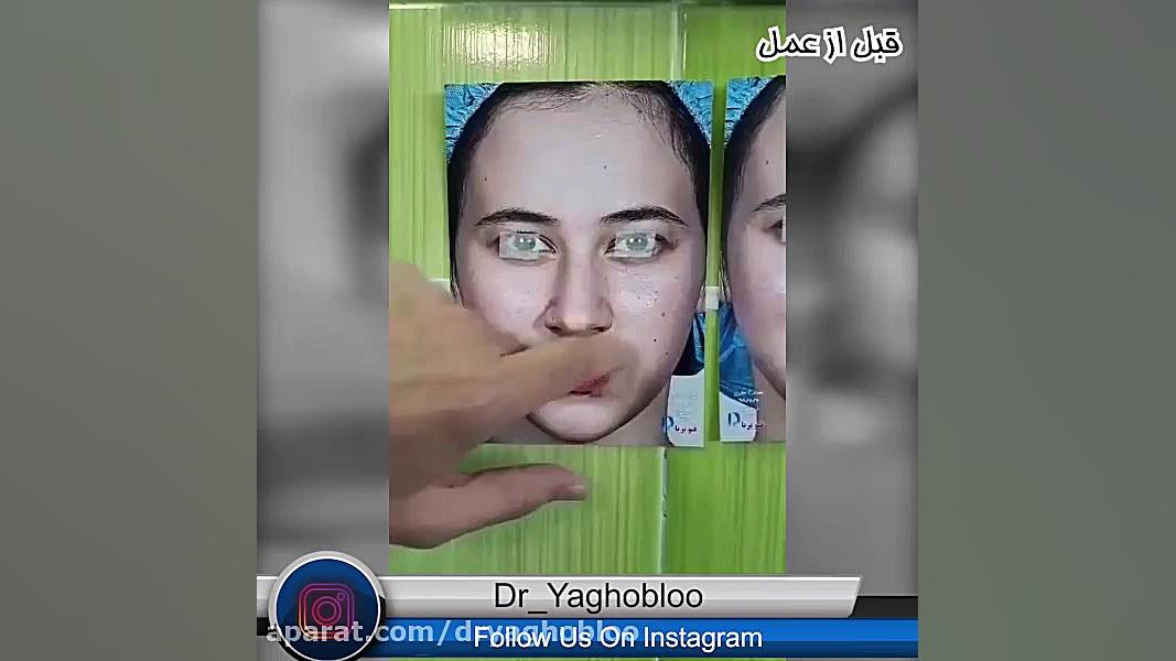 قبل و بعد از عمل زیبایی بینی | جراحی بینی لیزر مو