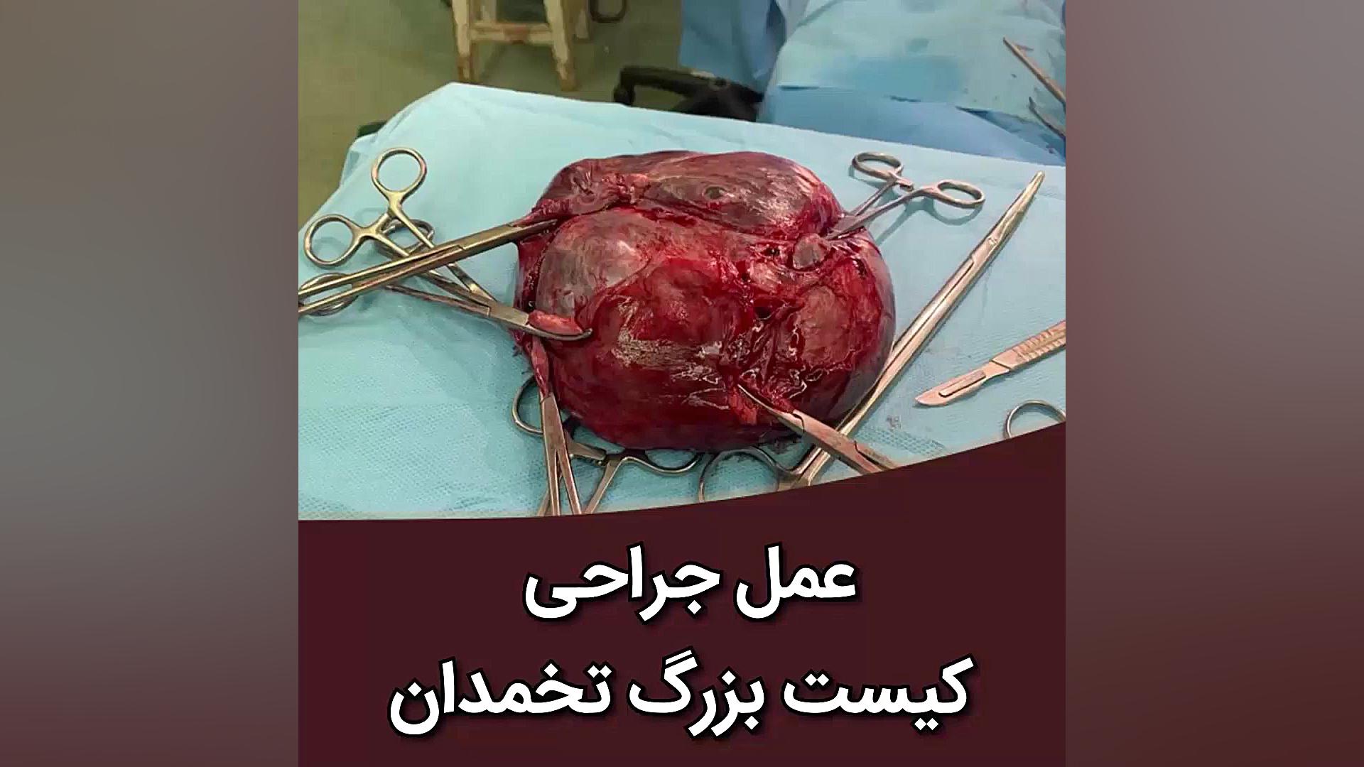 عمل جراحی کیست بزرگ تخمدان | دکتر فریده فرحبخش کلینیک مو
