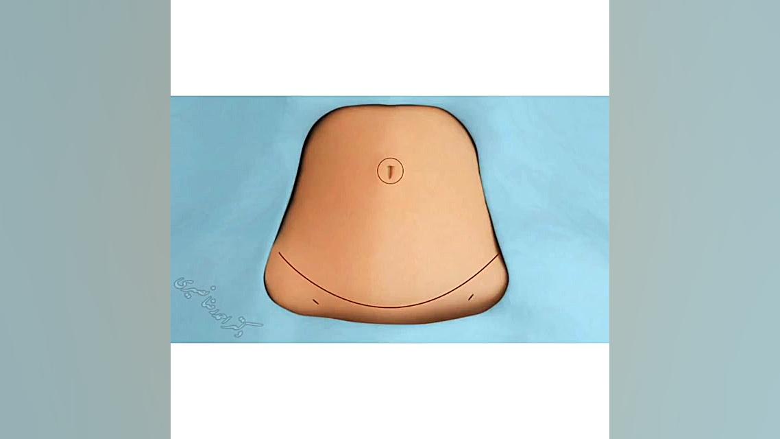 حذف پوست اضافه شکم دکتر احمدرضا نصیری