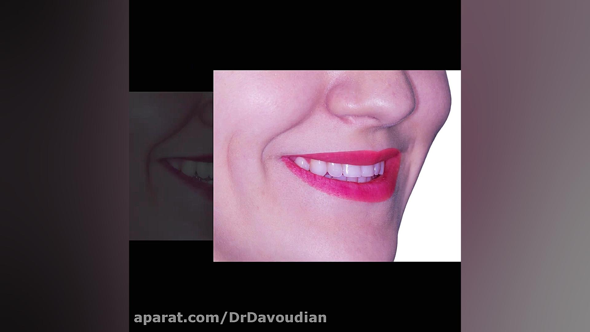 ارتودنسی بدون جراحی فک | دکتر داودیان جراحی فک