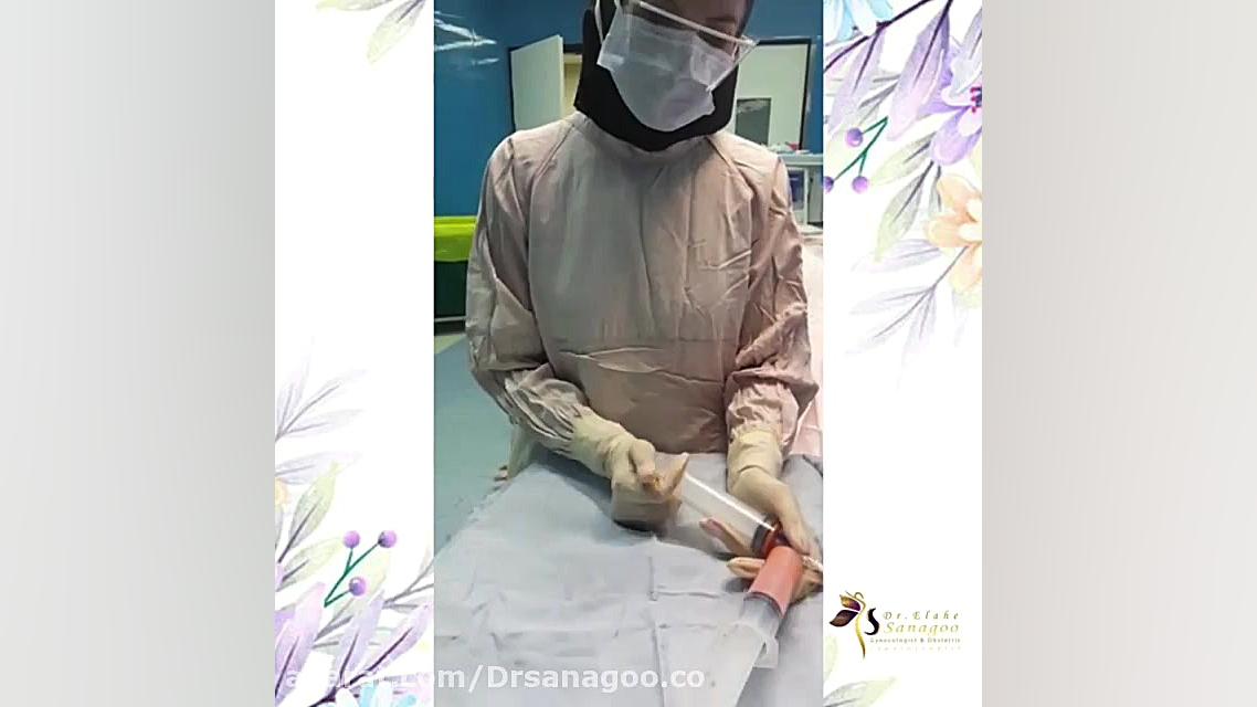 تزریق چربی به واژن روکش دندان