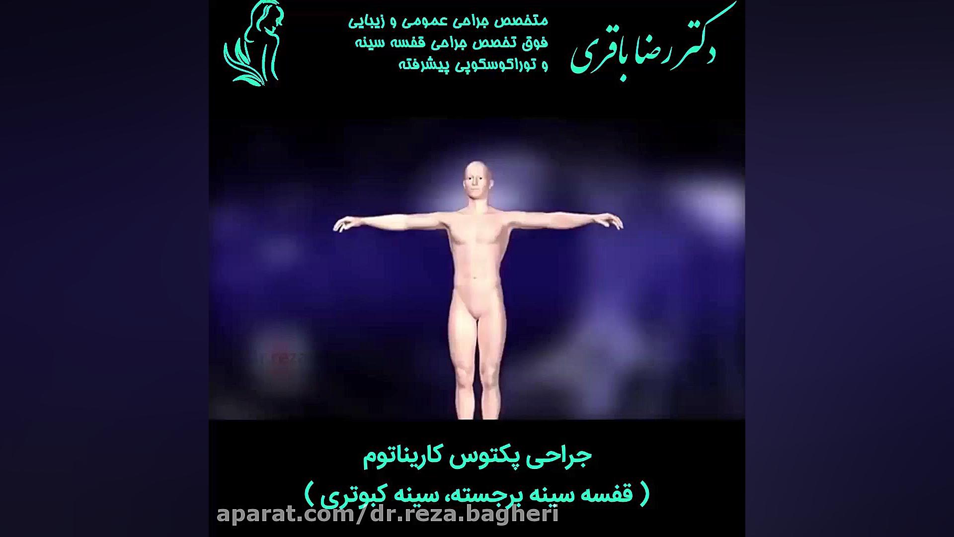 جراحی پکتوس کاریناتوم دکتر رضا باقری جراح سینه در مشهد