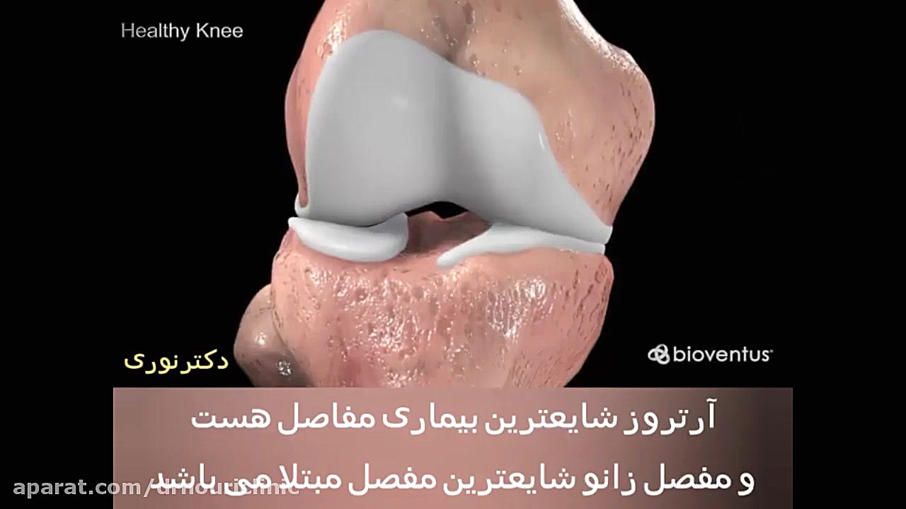 آرتروز زانو دکتراسماعیل نوری