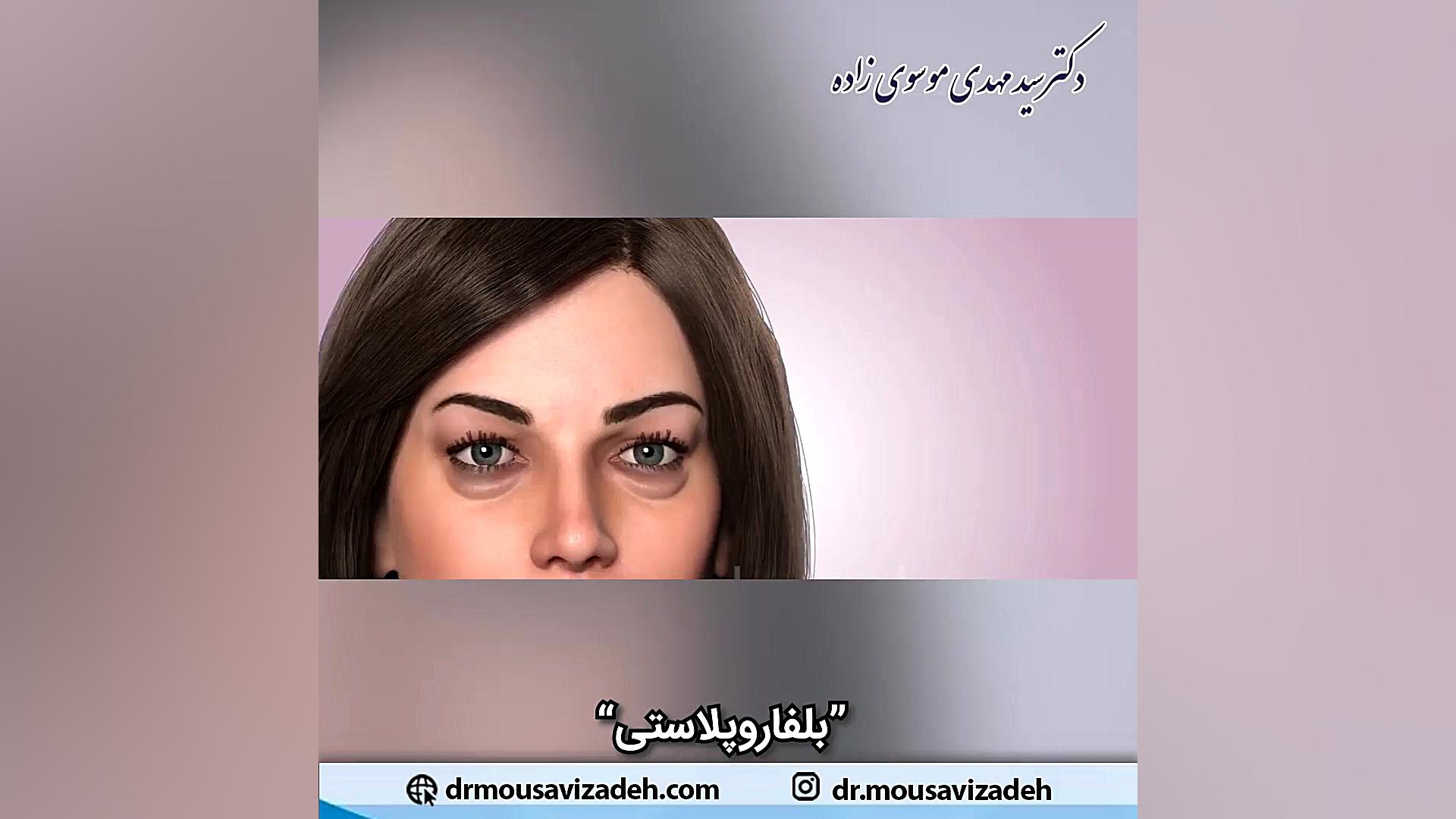 فیلم بلفاروپلاستی یا جراحی زیبایی پلک تست مهارکننده کمپلیمانت